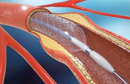 Coronary catheter illustration