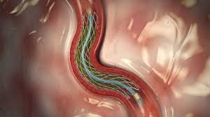 Coronary stent deployed in artery
