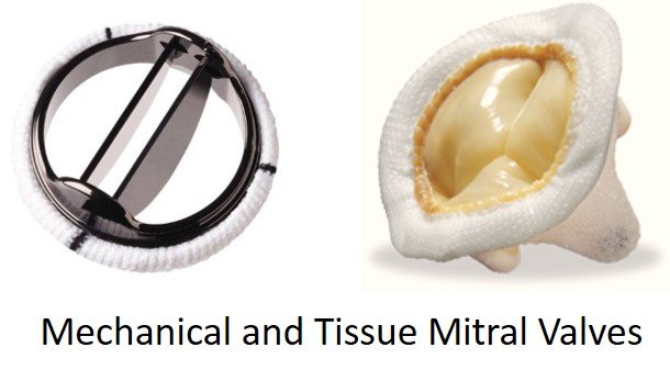 Mechanical and tissue mitral valves